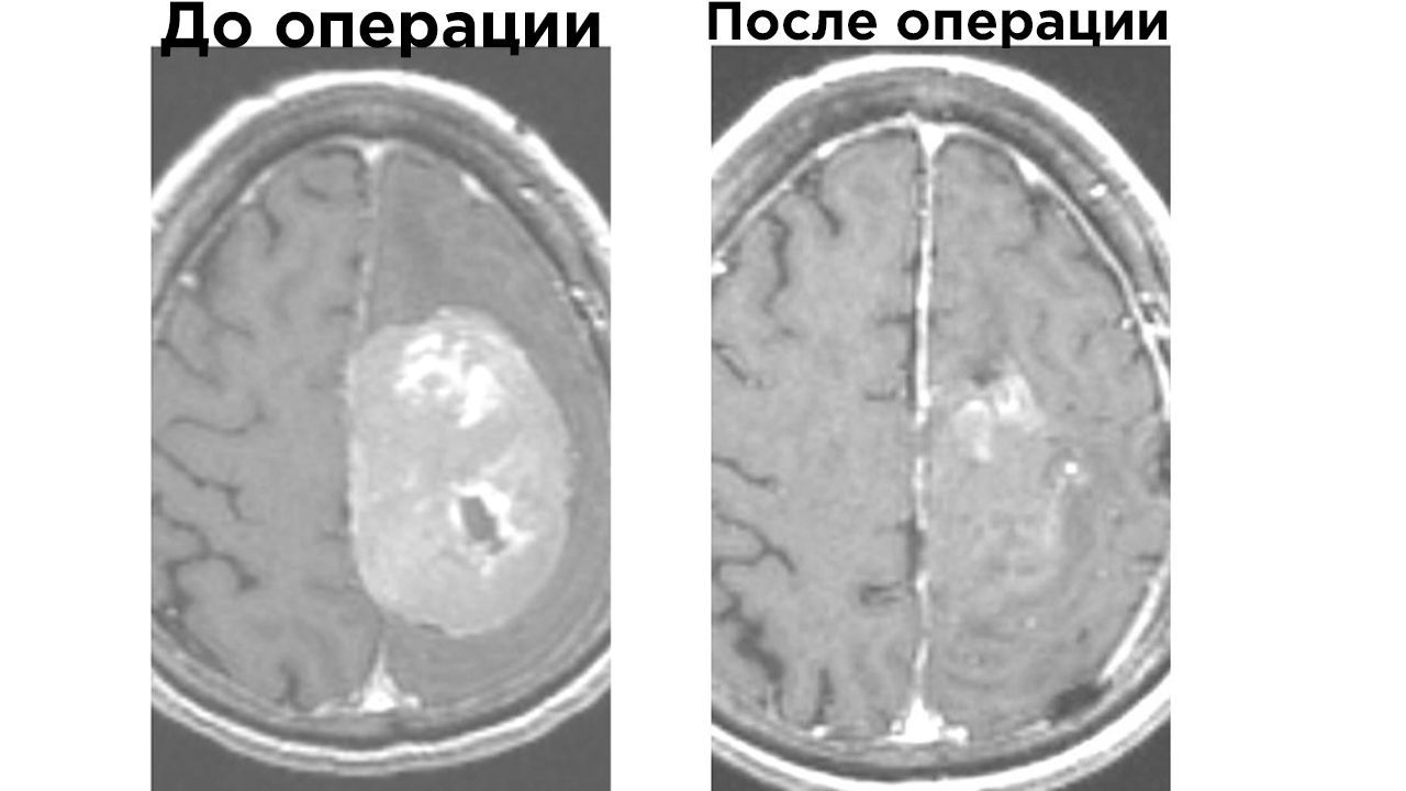 В Бурятии спасли пациентку с опухолью мозга, шесть лет отказывавшуюся от  операции