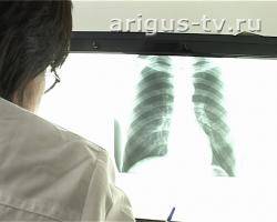 В Бурятии с каждым годом больных туберкулезом становится больше  почти на 1,5 тысячи