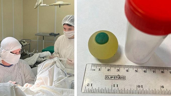 Врачи извлекли силиконовый глаз из кишечника 9‑летнего мальчика