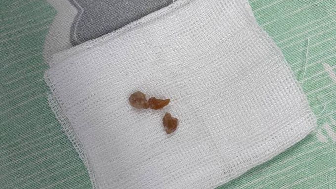 Годовалый малыш едва не погиб из-за конфеты в Иркутске 