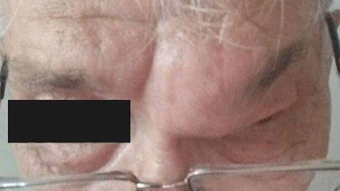 Мужчине с огромным новообразованием на лбу помогли врачи в Улан-Удэ