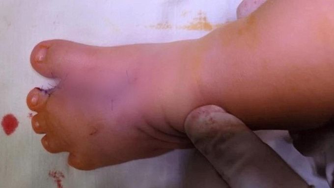 Малышу с врождёнными пороками рук и ног помогли врачи в Иркутске