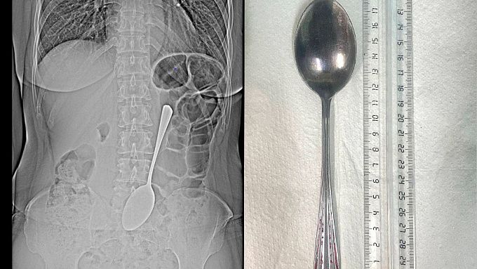 Улан-удэнка проглотила столовую ложку