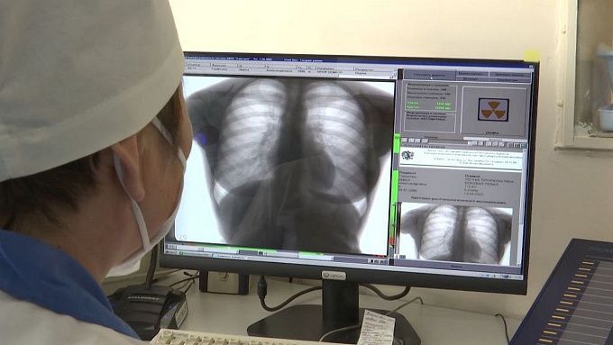 Жители Бурятии стали реже умирать от туберкулеза