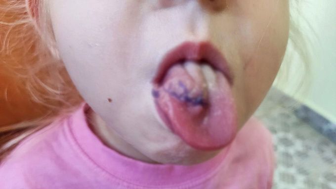«Залезла на стул, и не удержалась»: В Иркутске восстановили порванный язык девочке из Бурятии