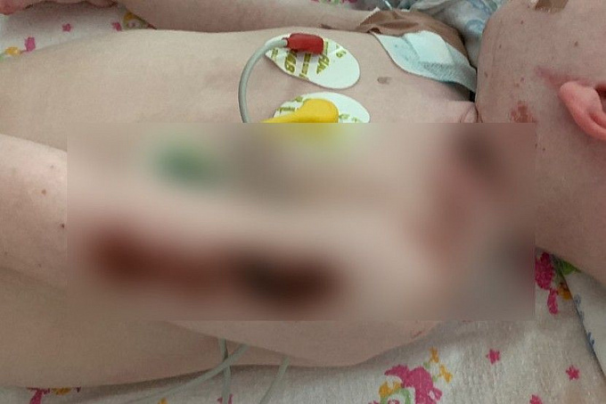 В Улан-Удэ спасли ребенка, выпившего отбеливатель