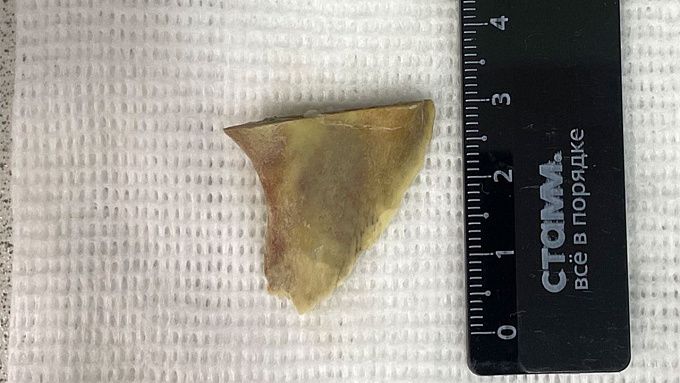 Улан-удэнец несколько дней мучился от застрявшей в пищеводе кости