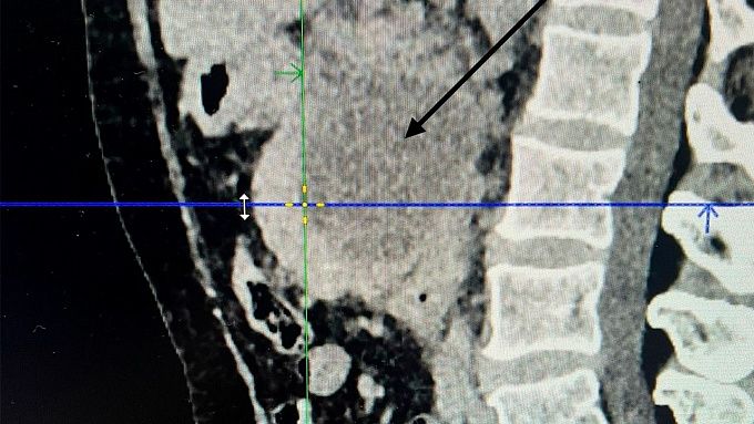 Уникальную операцию на поджелудочной провели хирурги Бурятии