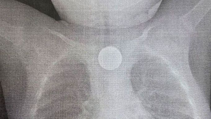 Годовалого малыша спасли от смерти в Улан-Удэ