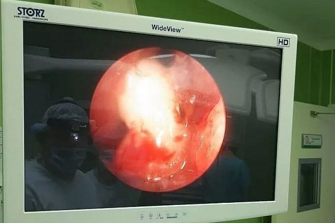 ШОК: В Иркутске врачи удалили зуб из носа подростка