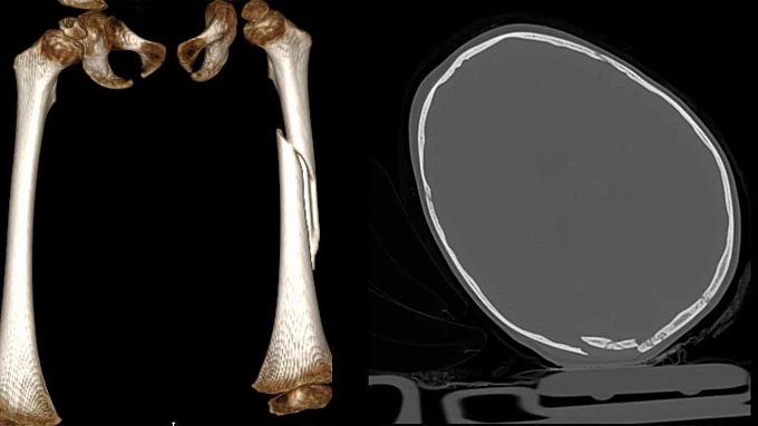 Ребенок, выпавший из окна в Улан-Удэ, находится в крайне тяжелом состоянии