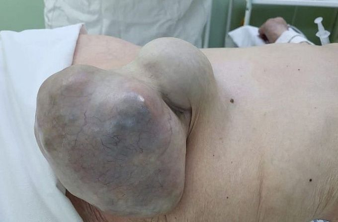 В Бурятии прооперировали 91-летнюю женщину с гигантской грыжей