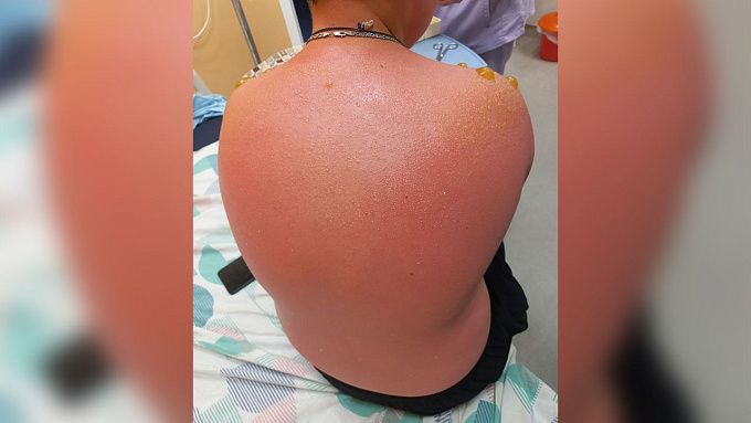 В Бурятии ребенок попал в больницу из-за солнечного ожога