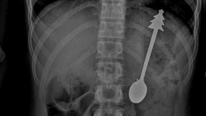 14-сантиметровую ложку проглотил ребенок в Оренбургской области 