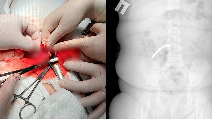 20 магнитных шариков проглотил двухлетний малыш в Улан-Удэ